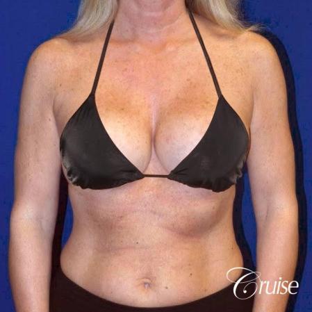 Breast Lift - Saline Augmentation - After Image 4