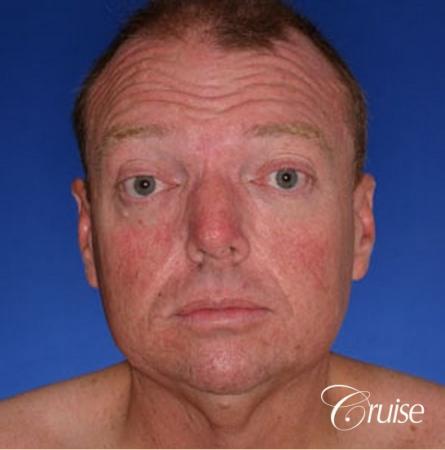 best male chin implant with large square jaw - Before Image 1
