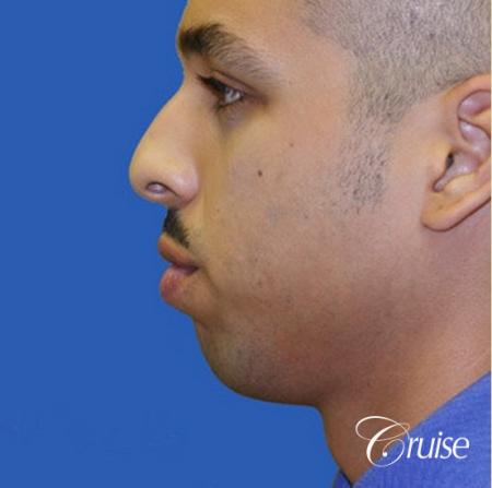 male patient with best pictures of chin implant - Before Image 2