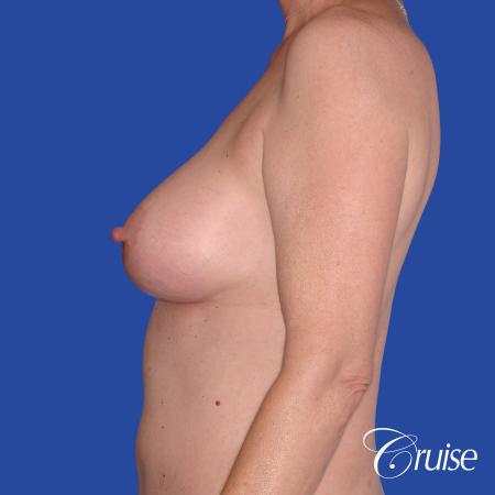 Breast Augmentation - After Image 2