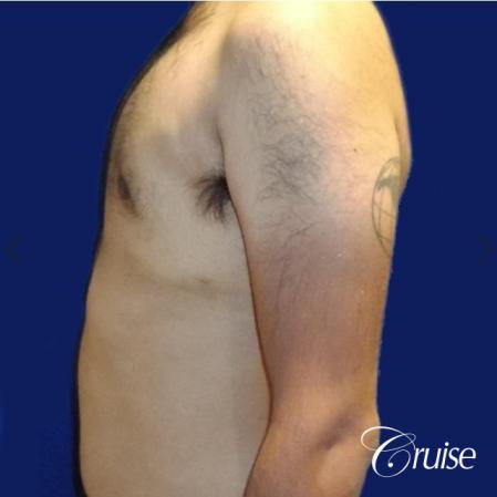 Moderate Gynecomastia Areola Incision - After Image 2