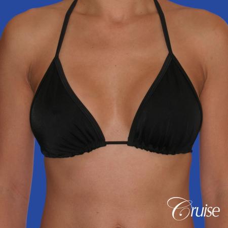 Breast Augmentation - After 3