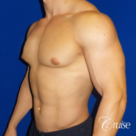 Type 1 Body Builder Puffy Nipple Correction - Before 2