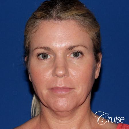 best small anatomic implant photos - Before Image 1
