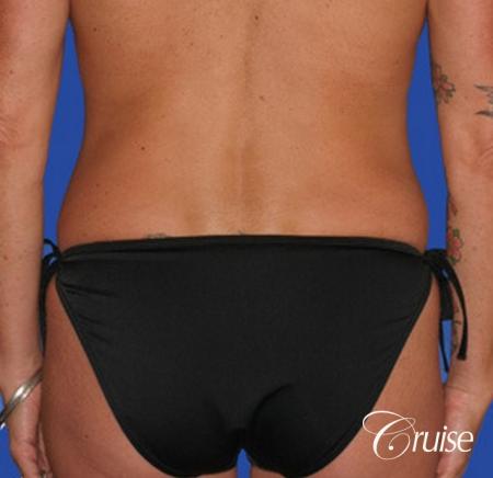 best female liposuction for small waist Newport Beach - After Image 1