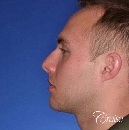 best chin implant on male with medium square jaw - After Image 2