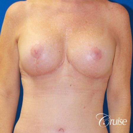best breast lift revision with saline 270cc - After Image 1
