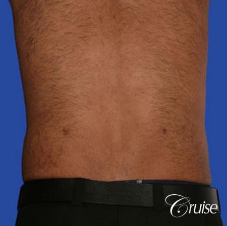 best liposuction abdomen and flanks on a male patient - After Image 2