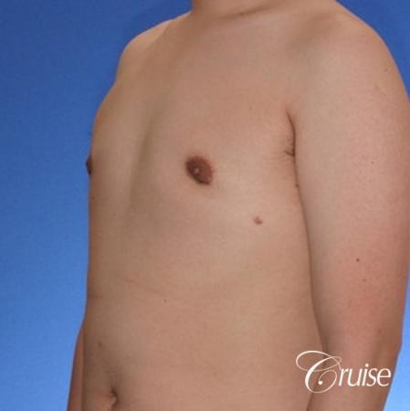 young male with mild gynecomastia surgery for puffy nipple - After Image 3