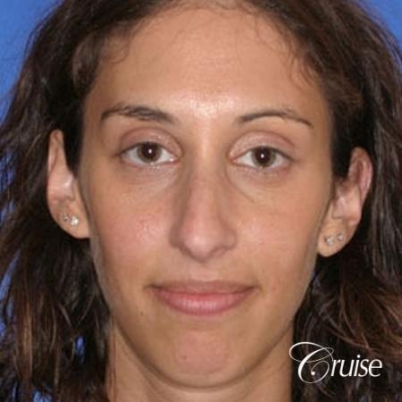 29 yr old with large female chin augmentation - Before Image 1
