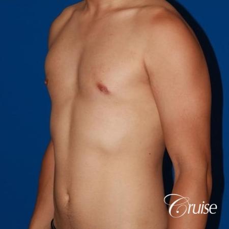 young athletic adult with puffy nipple - After Image 2