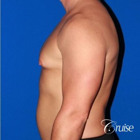 body builder with Gynecomastia puffy nipple - Before Image 2