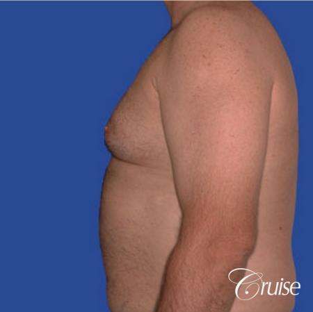 chest liposuction on adult - Before Image 2