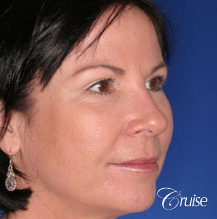 best plastic surgery on upper eyelids - After Image 3