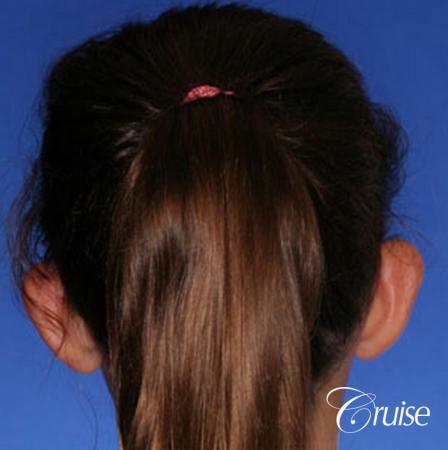 best otoplasty pictures on adolescent child teen - Before and After Image 3