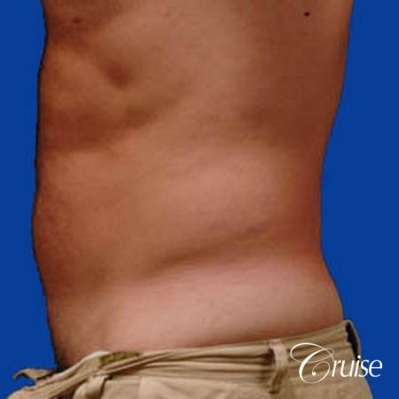 best male ab sculpting liposuction abdomen flanks - Before Image 2