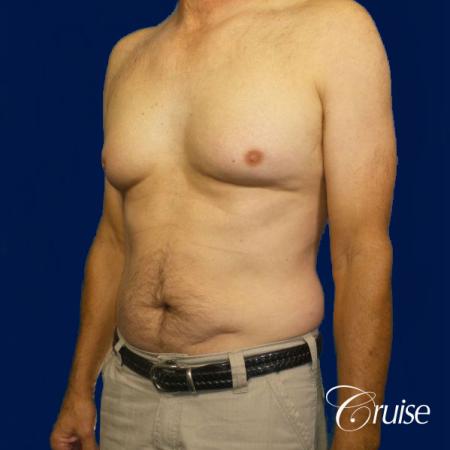 Moderate Gynecomastia Pedicle - Before Image 3