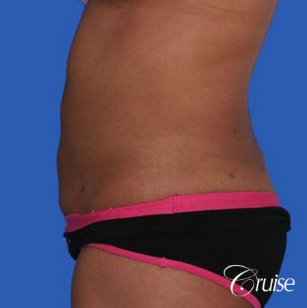 small waist with liposuction abdomen and flanks - After Image 2