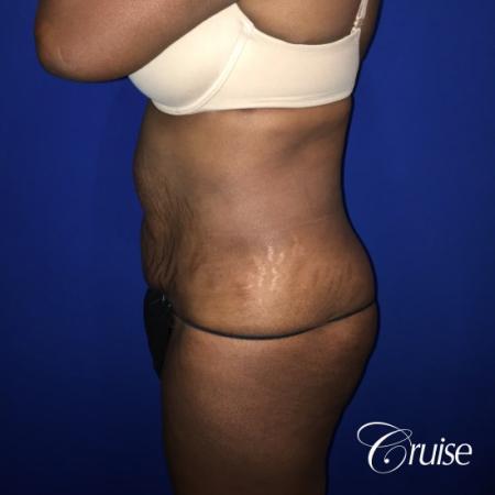 Best Tummy Tucks Orange County CA - Before Image 3