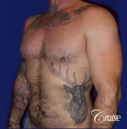 Moderate Gynecomastia -Areola Incision - After Image 4