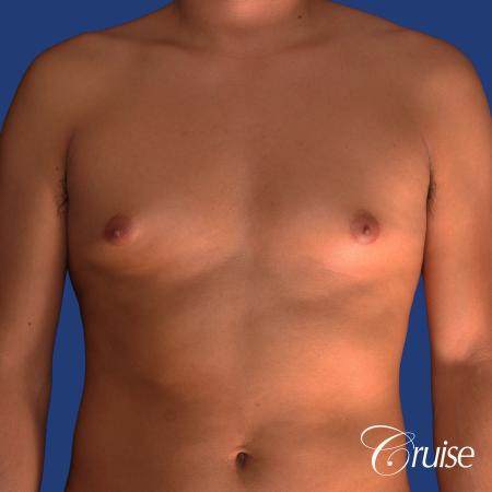 best gynecomastia results with plastic surgeon and specialist - Before Image 1