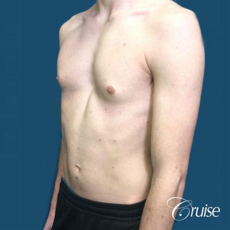 Top Gynecomastia Specialist Dr. Cruise - Before Image 3