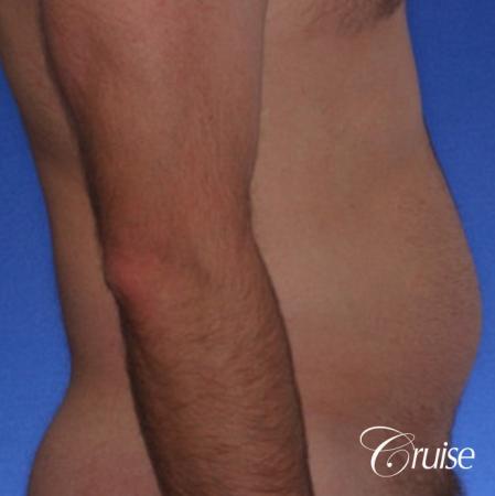 male muffin top liposuction pictures - Before and After Image 2