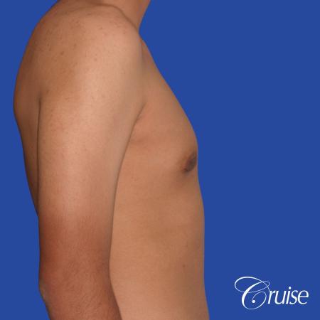 gynecomastia patient gets nipple reduction for best results - After Image 4