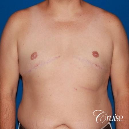 male breast severe gynecomastia free nipple graft anchor - After Image 1