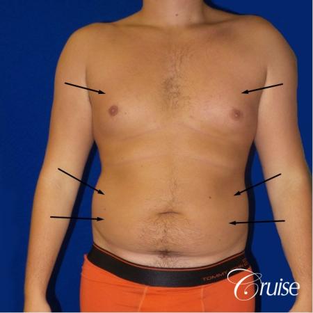 Best before and after lipo photos of guys - Before Image 1