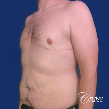 Pedicle incision Dr. Cruise Newport Beach CA - After Image 3
