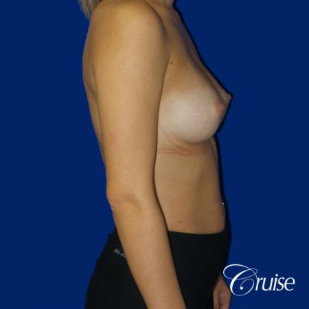 Breast Augmentation - After Image 4