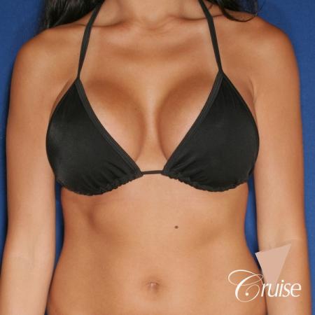 best breast lift anchor with silicone augmentation in Orange County - After Image 4
