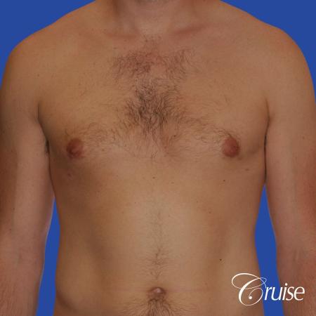young adult with puffy nipple gets the best results with top gynecomastia surgeon - After Image 1