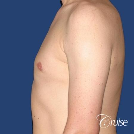 moderate gynecomastia on adult donut lift - After Image 2