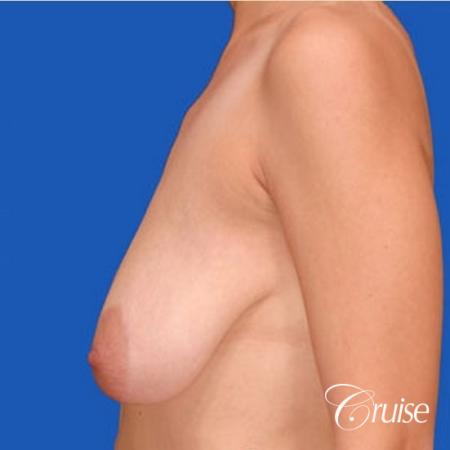 best results for breast lift anchor with top plastic surgeon - Before and After Image 2
