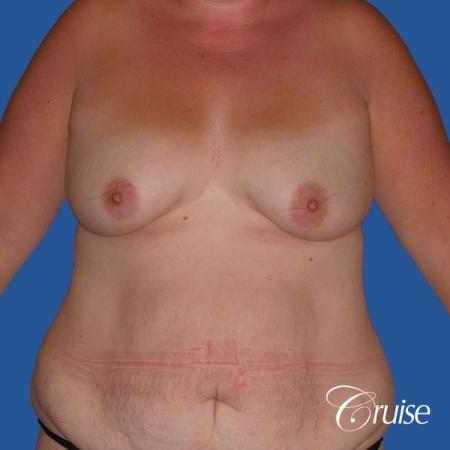 best mommy makeover and breast lift anchor results - Before Image 1