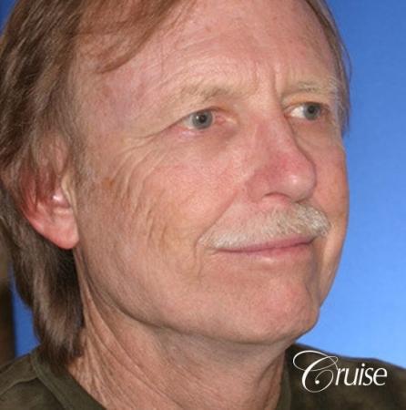 62 yr old with medium square chin augmentation - Before and After Image 3