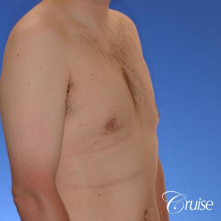 moderate gyne on 31 yr old male - After Image 4
