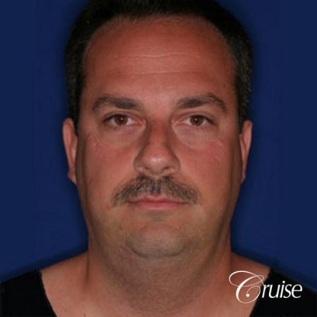 terino square jaw implant after best chin augmentation - Before Image 1