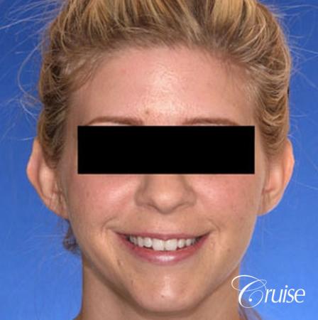 best otoplasty photos by top plastic surgeon - Before Image 1