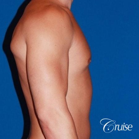 32 yo with Gynecomatia and Puffy Nipple - After Image 4