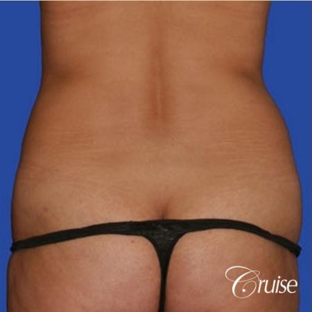 mommy makeover with silicone lollipop lift with best scars - Before and After Image 3