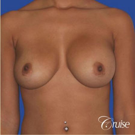 best pictures of ruptured implant breast revision - Before Image 1