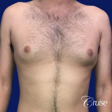 Moderate Gynecomastia Areola Incision - Before Image 1