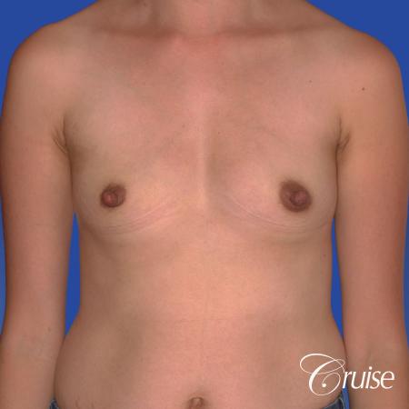Breast Augmentation: Patient 42 - Before Image 1