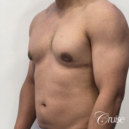 gynecomastia surgery - After 3