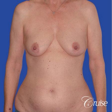 low mini tummy tuck with D cup breast augmentation - Before Image 1