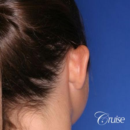 best otoplasty pictures on adolescent child teen - Before Image 2