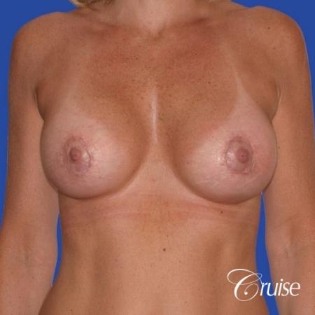 breast lift anchor with silicone implants on adult - After Image 1